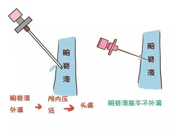 麻醉手術(shù)后不需要去枕平臥了 你知道嗎？