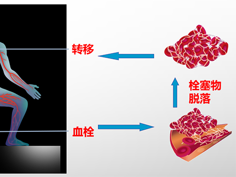 優(yōu)勢學(xué)科|錦州市中心醫(yī)院心血管內(nèi)三科成功救治一名高危肺動(dòng)脈栓塞患者