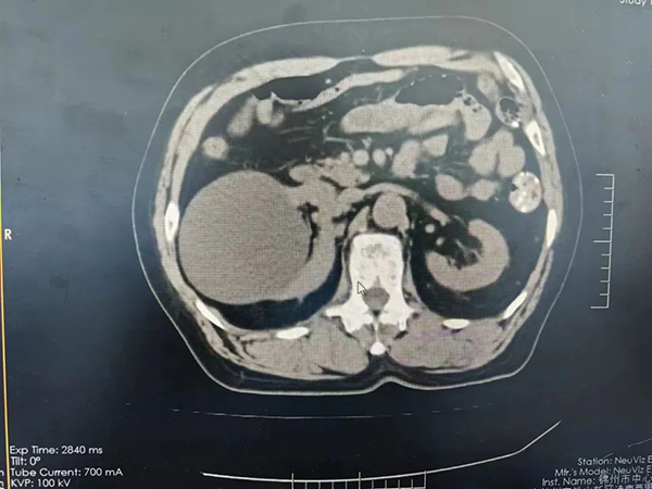 優(yōu)勢技術 | 腹腔鏡腎囊腫去頂減壓 20分鐘解決“大囊腫”