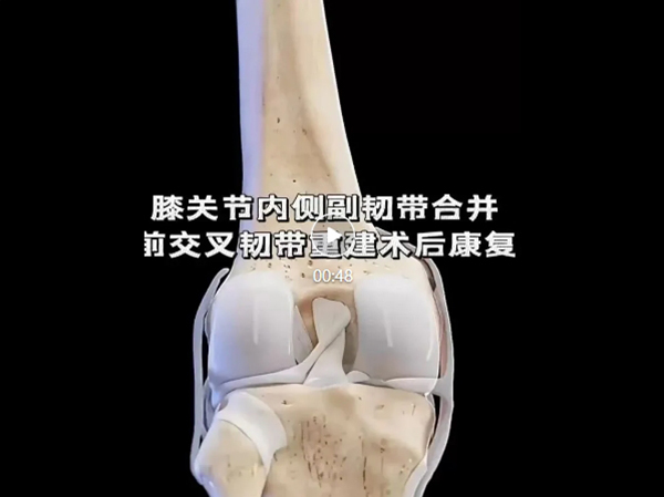 優(yōu)勢技術(shù) | 前交叉韌帶重建 手術(shù)不是終點(diǎn)術(shù)后康復(fù)加快重獲運(yùn)動(dòng)能力