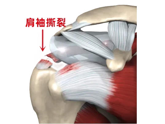 優(yōu)勢技術|肩袖損傷：肩關節(jié)鏡下縫合肩袖 小切口解決大麻煩