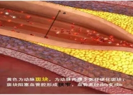 特色門診 | 頸動脈斑塊?？崎T診