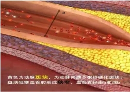 特色門診 | 頸動(dòng)脈斑塊?？崎T診