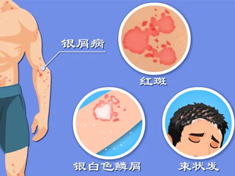 特色門診|銀屑病專科門診